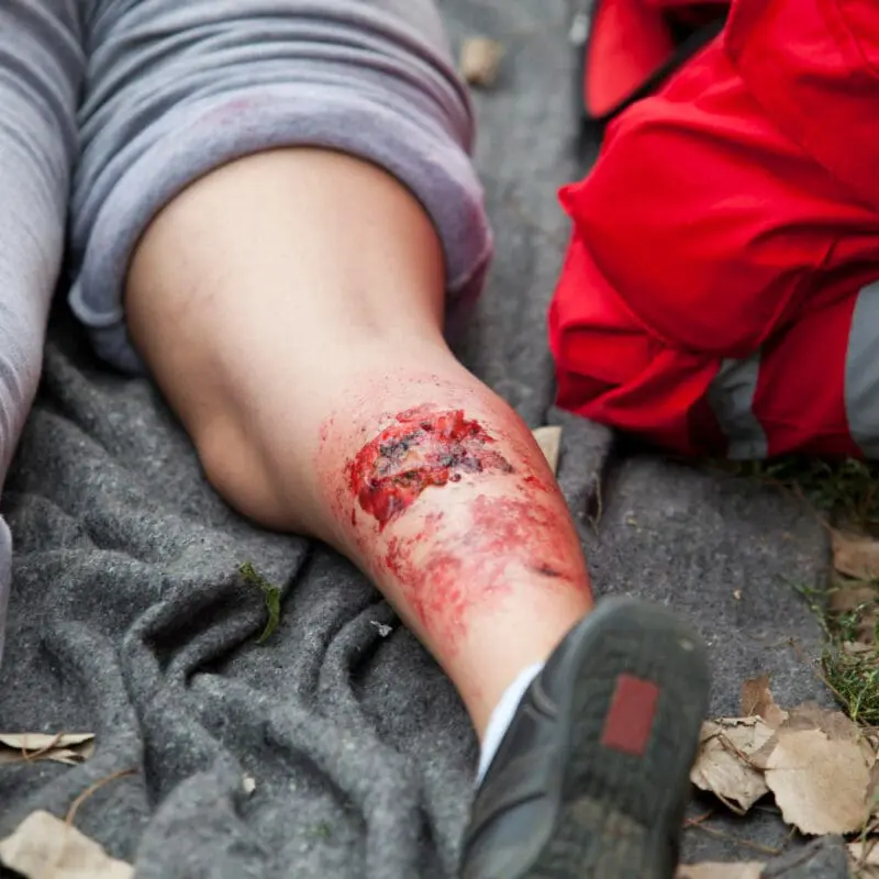 burn injury lawyer