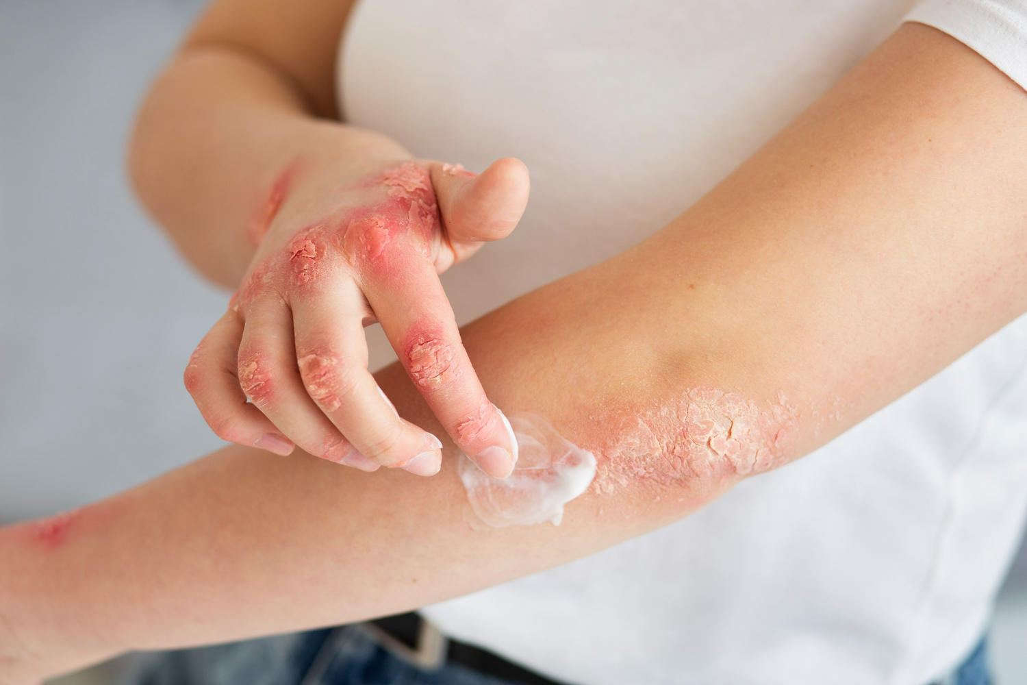 burn injury claims