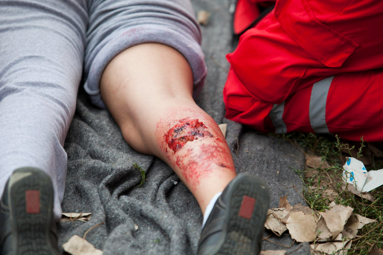 Common Misconceptions About Injury Claims and How a Burn Injury Lawyer Can Help