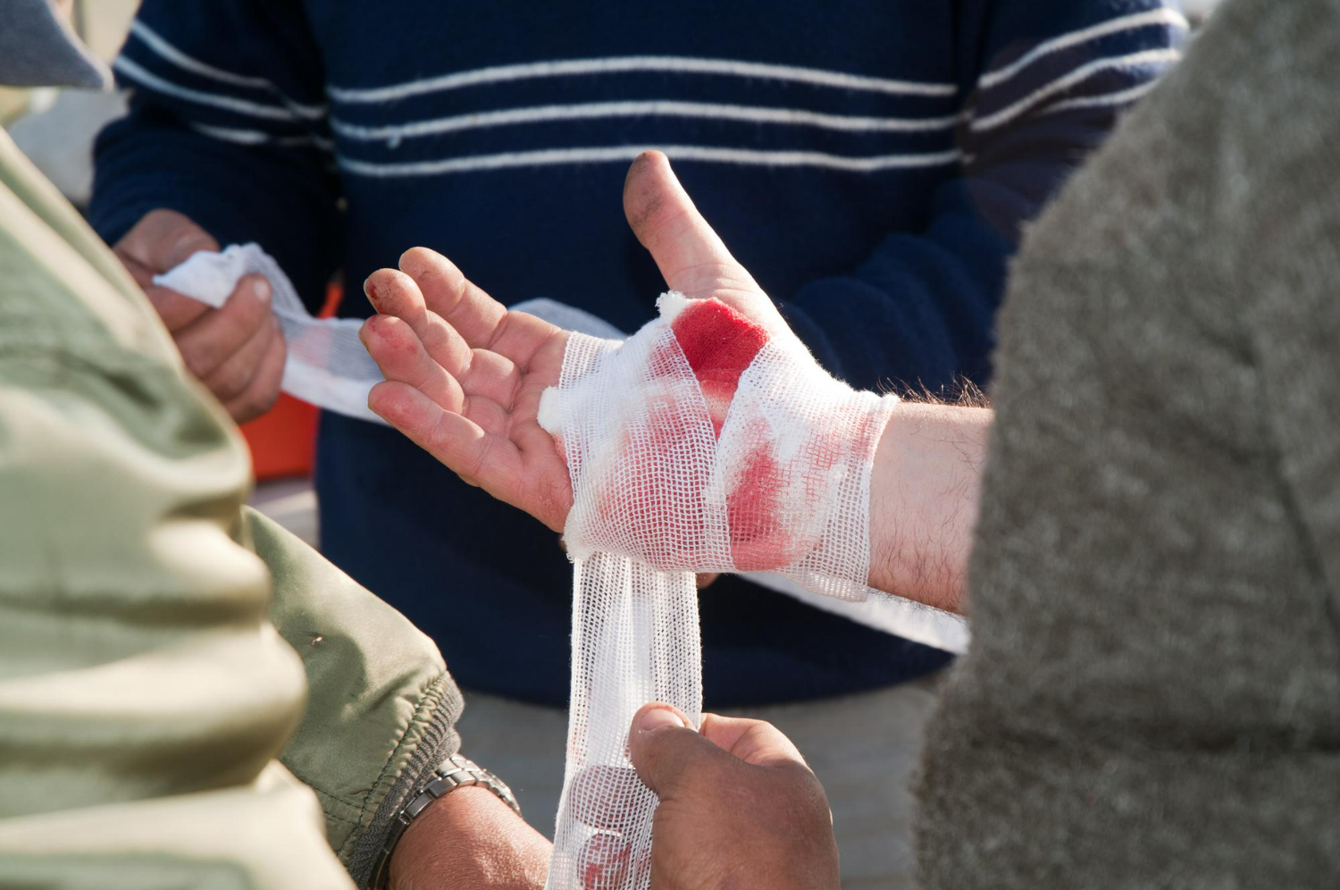 burn injury compensation